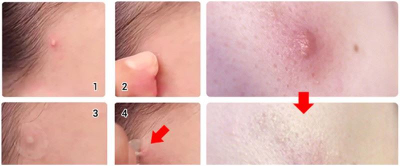 hydrocolloid patches