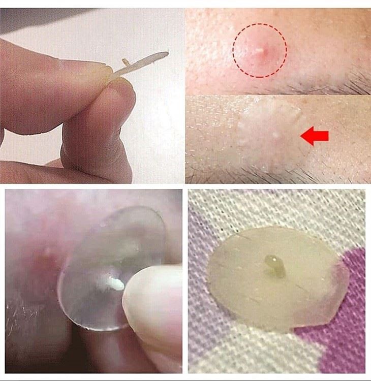 pimple patches how to use